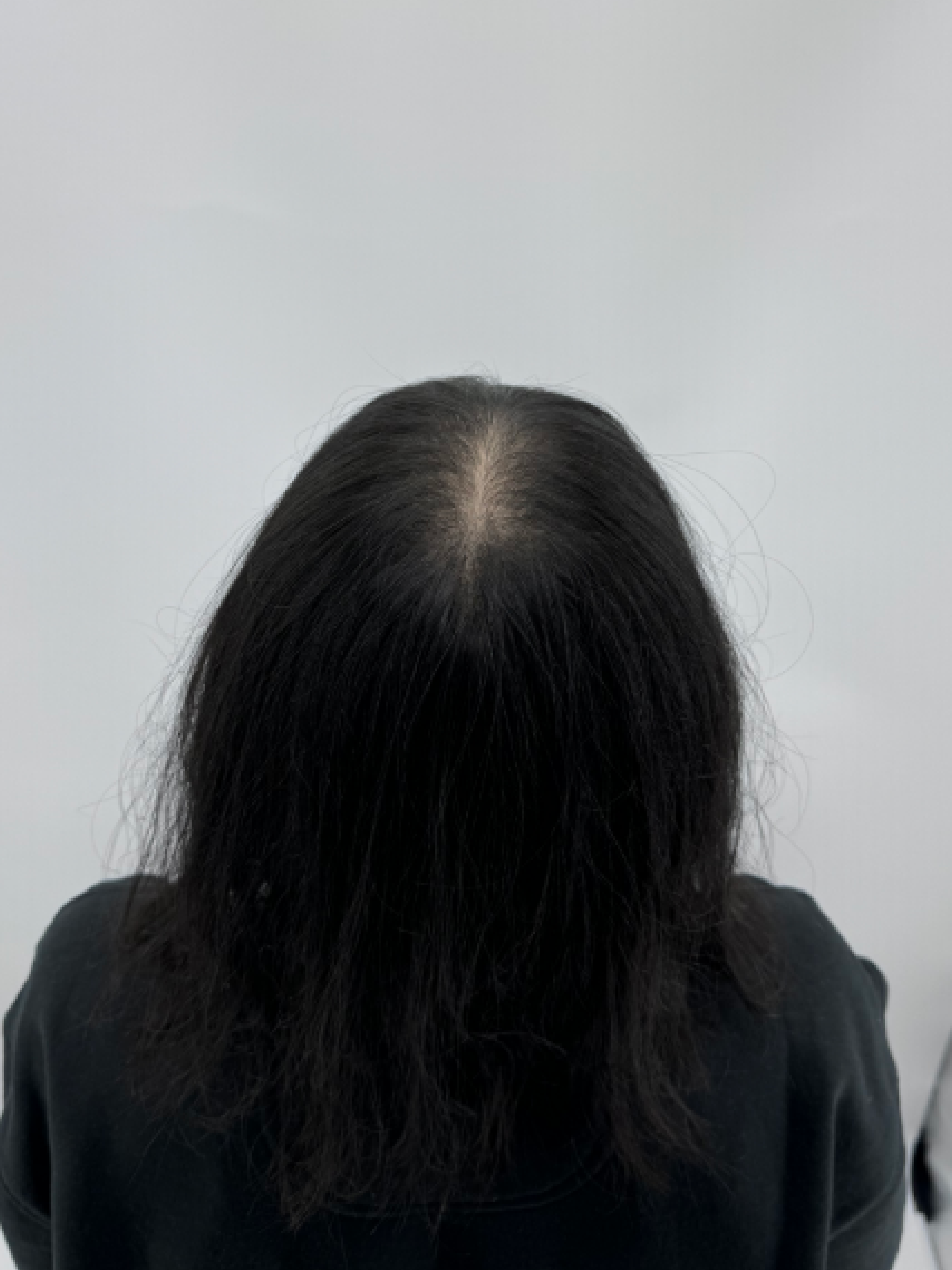 가르마 시술 - 시술 전