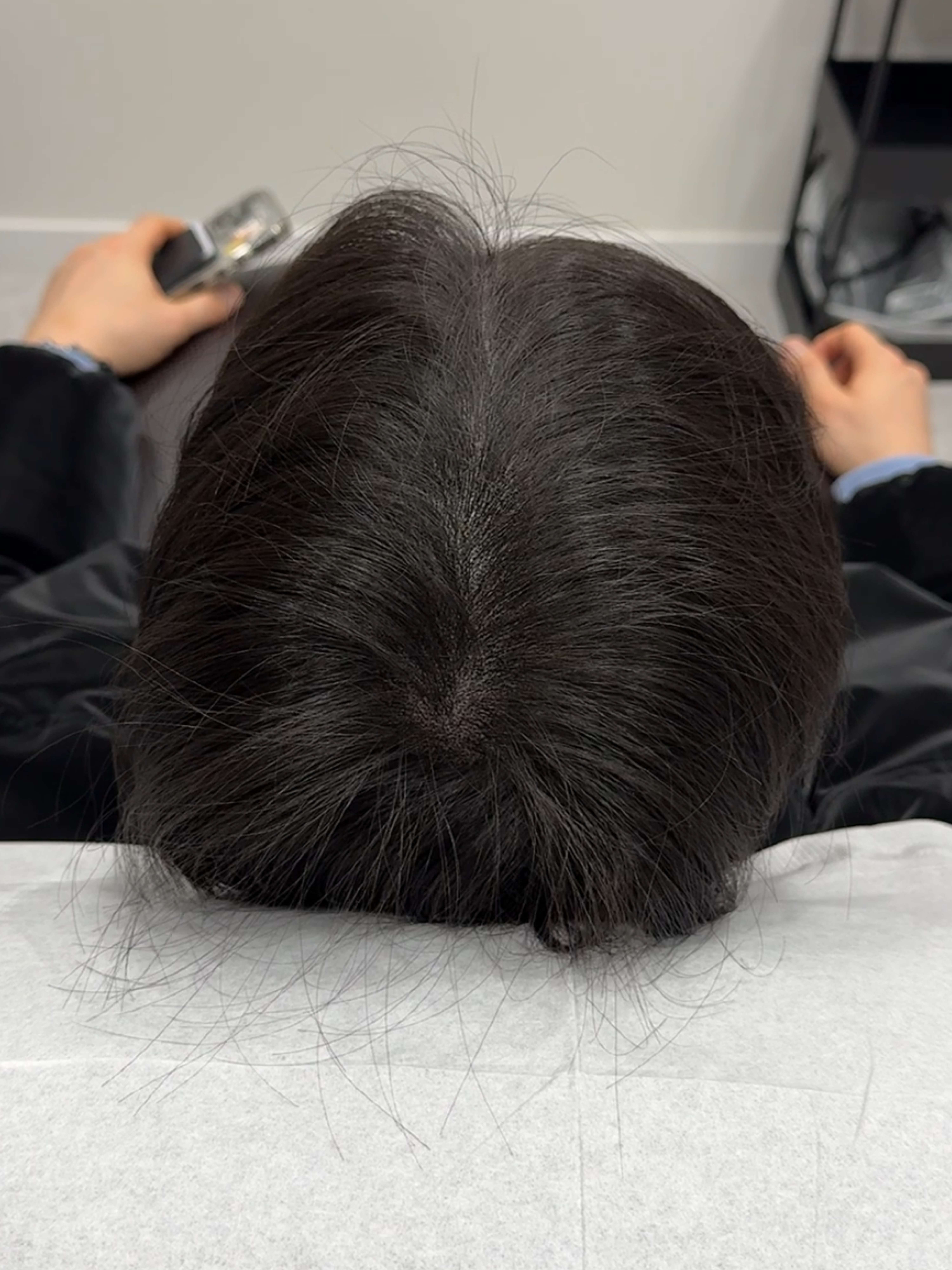 가르마 시술 - 시술 후