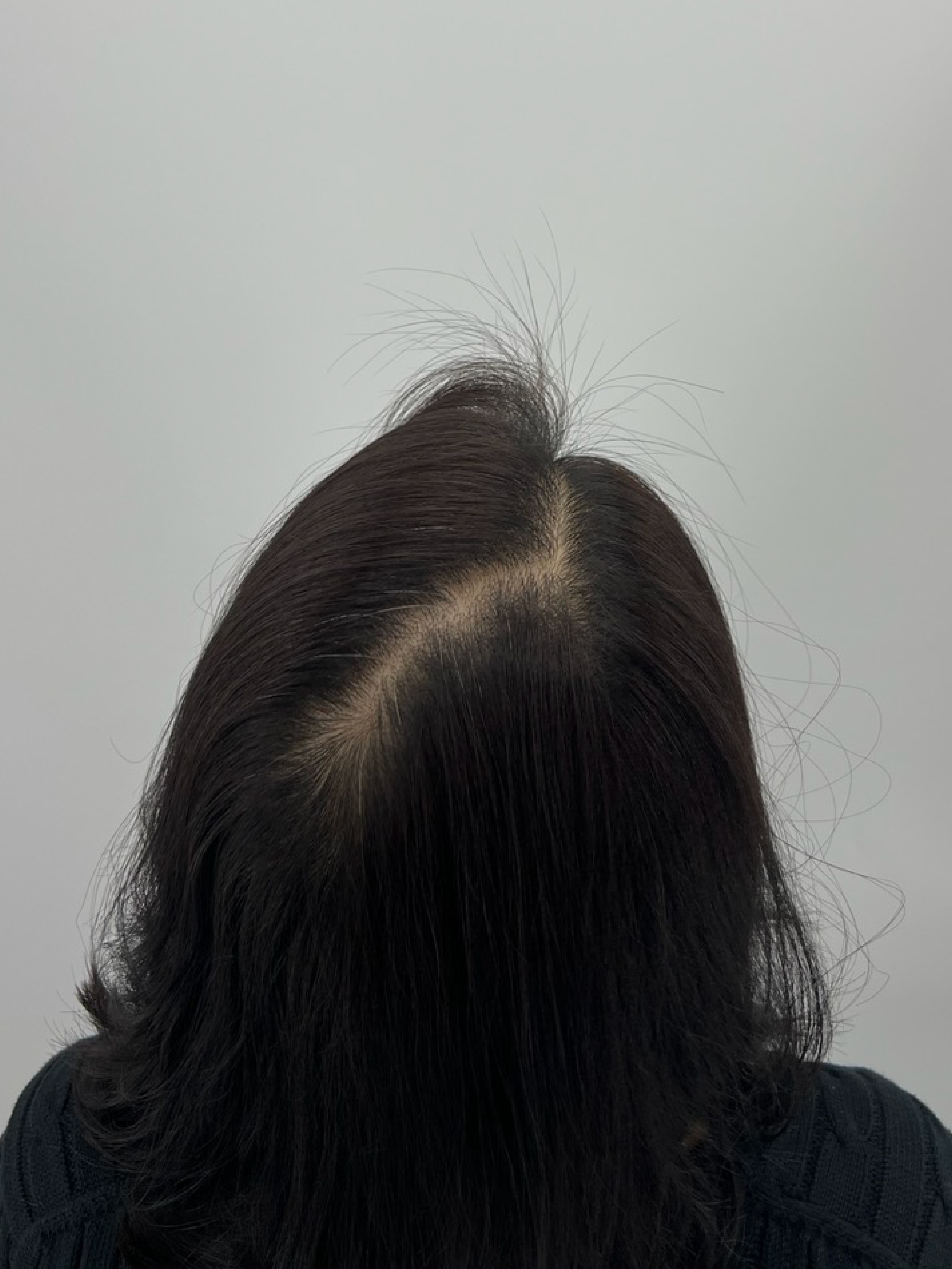 가르마 시술 - 시술 전