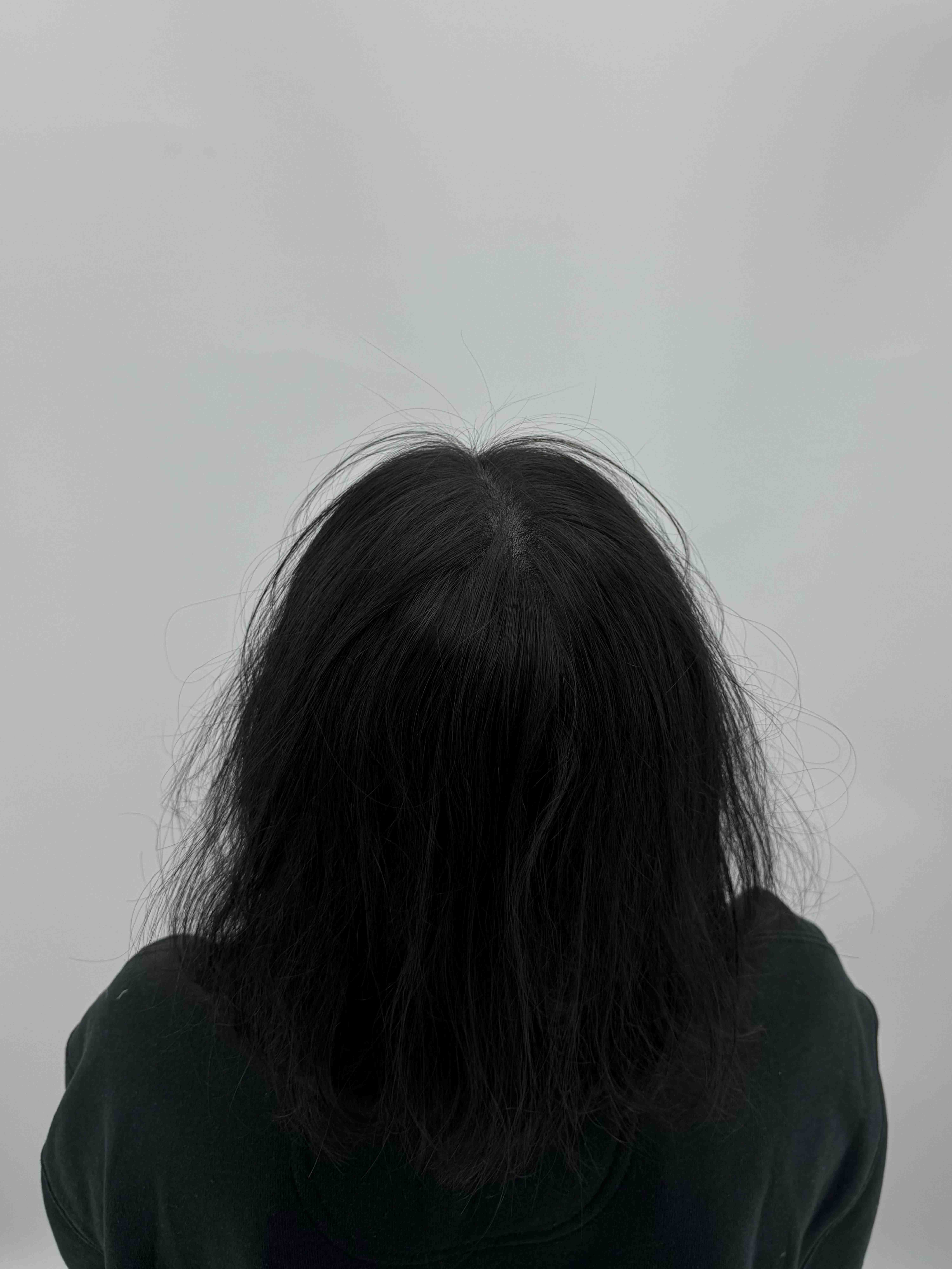 가르마 시술 - 시술 후