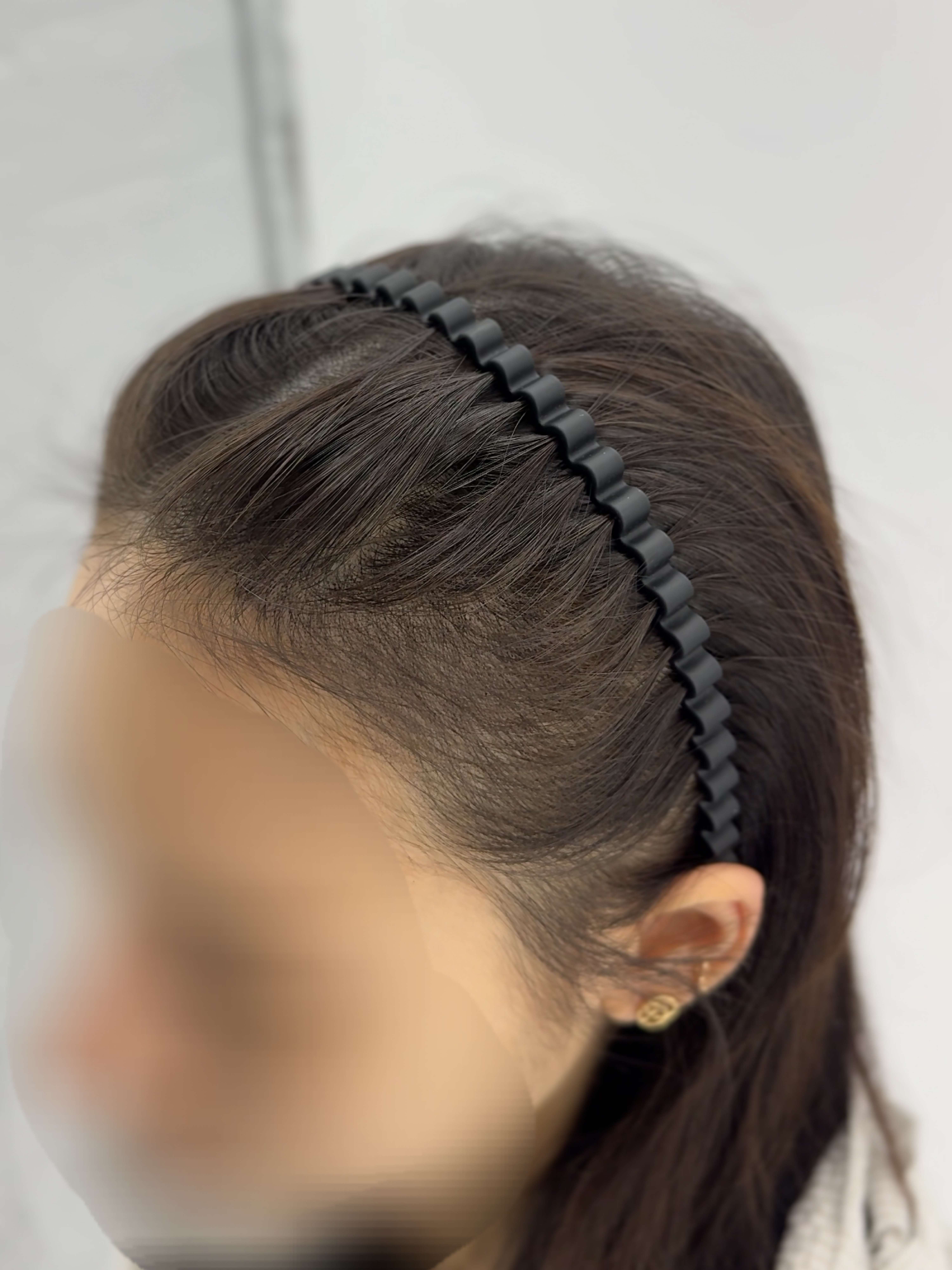 여성 헤어라인 시술 - 시술 후