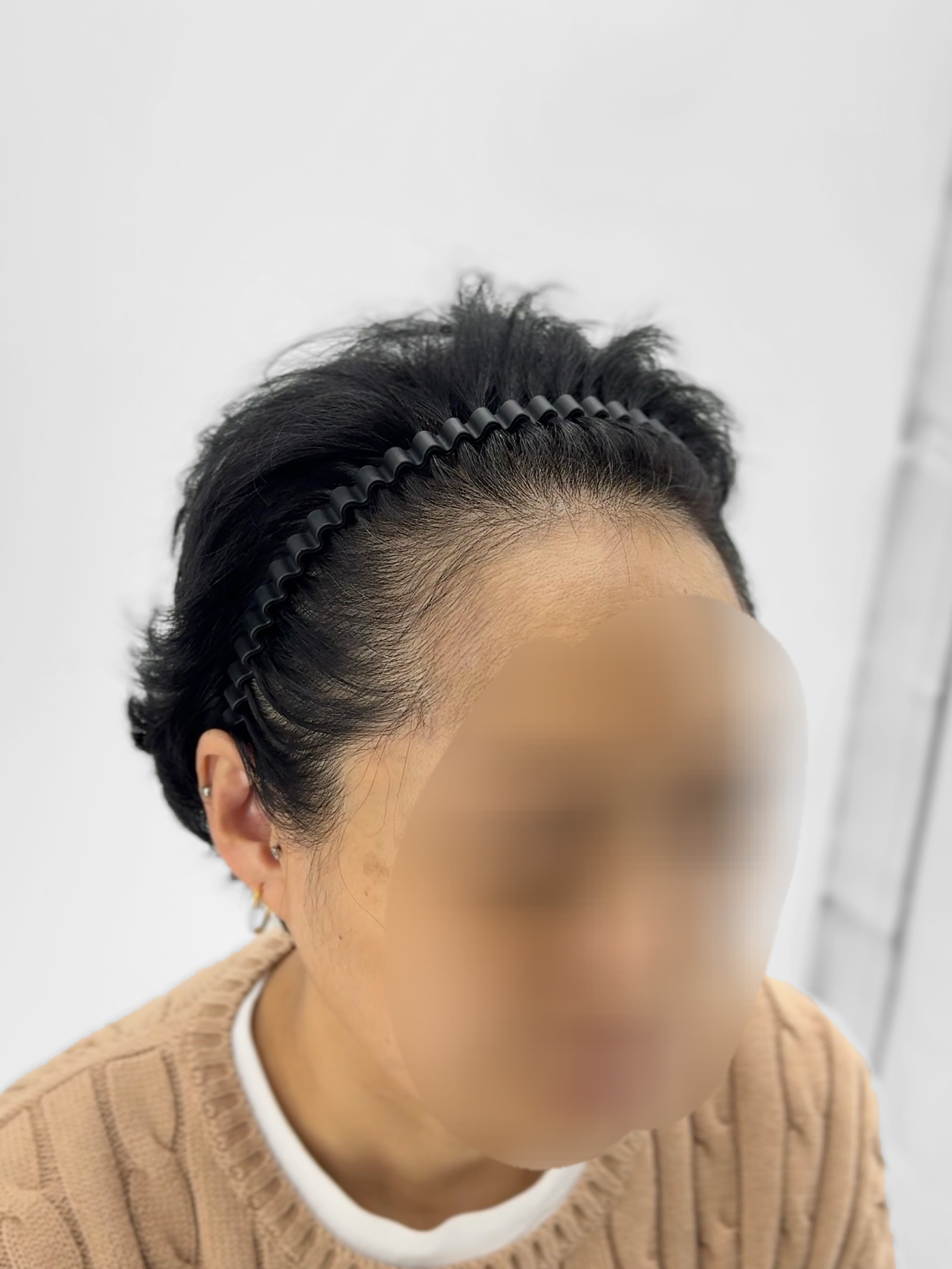 여성 헤어라인 시술 - 시술 전