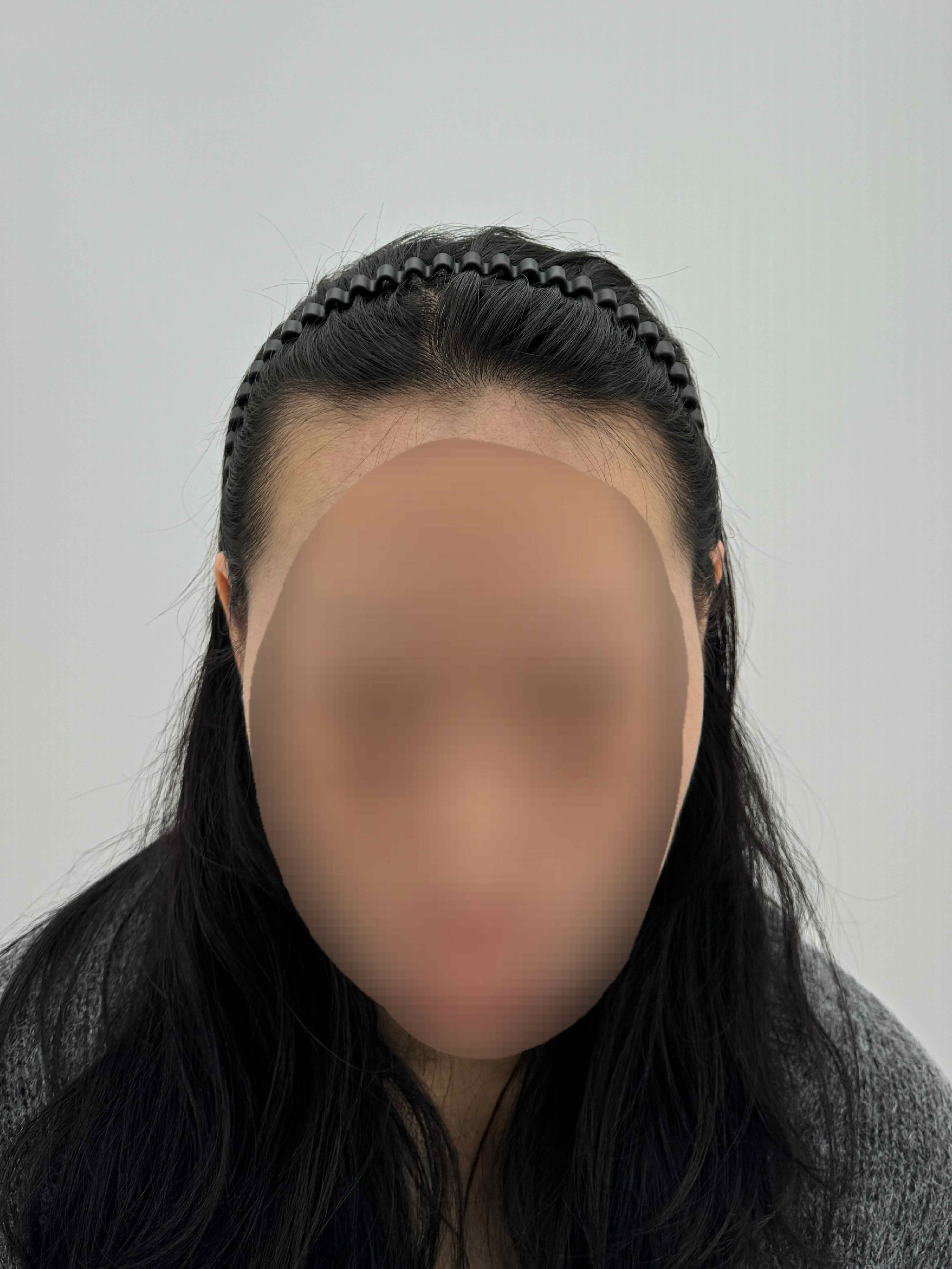 여성 헤어라인 시술 - 시술 전