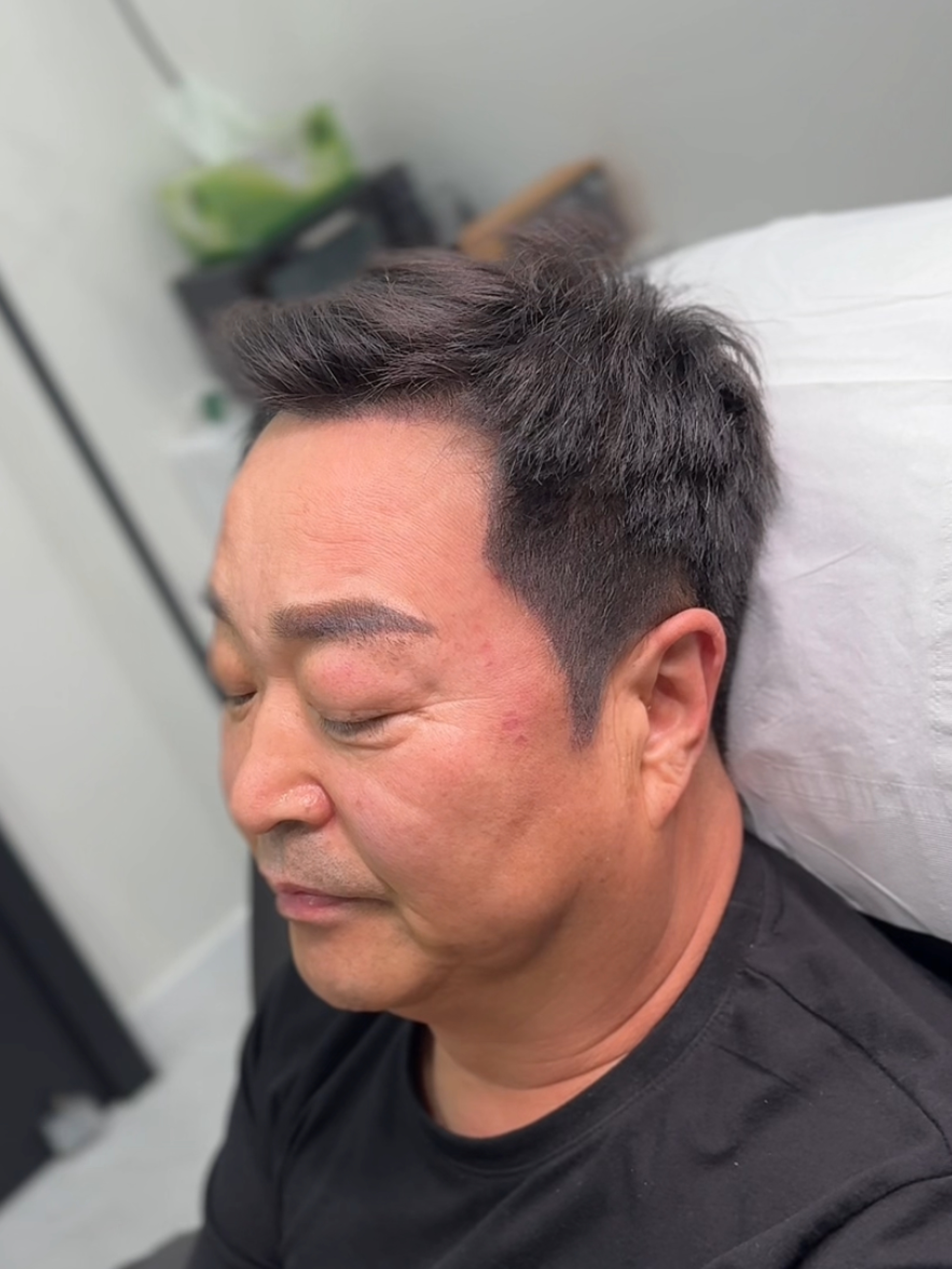 헤어라인 시술 후