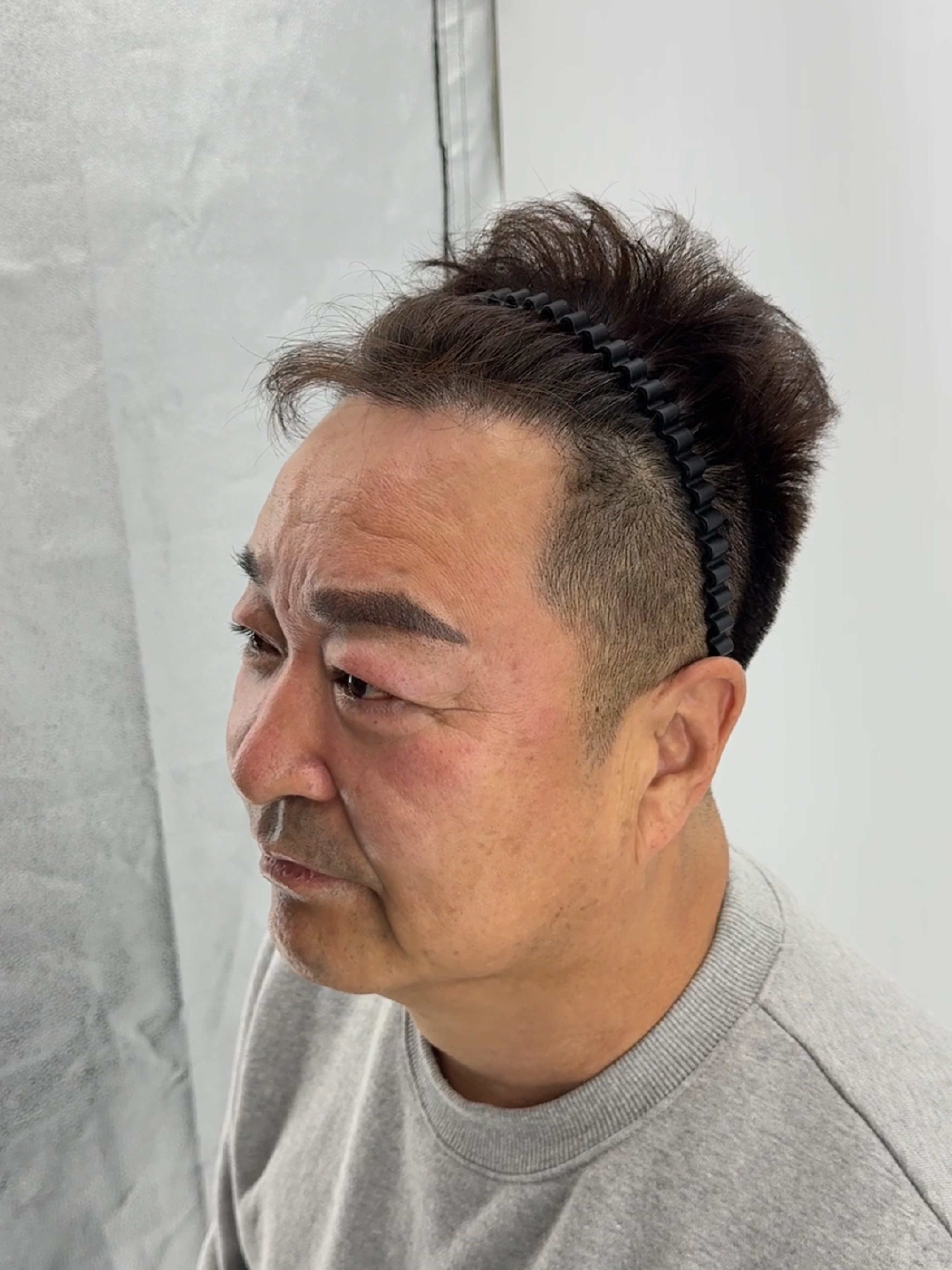 헤어라인 시술 전