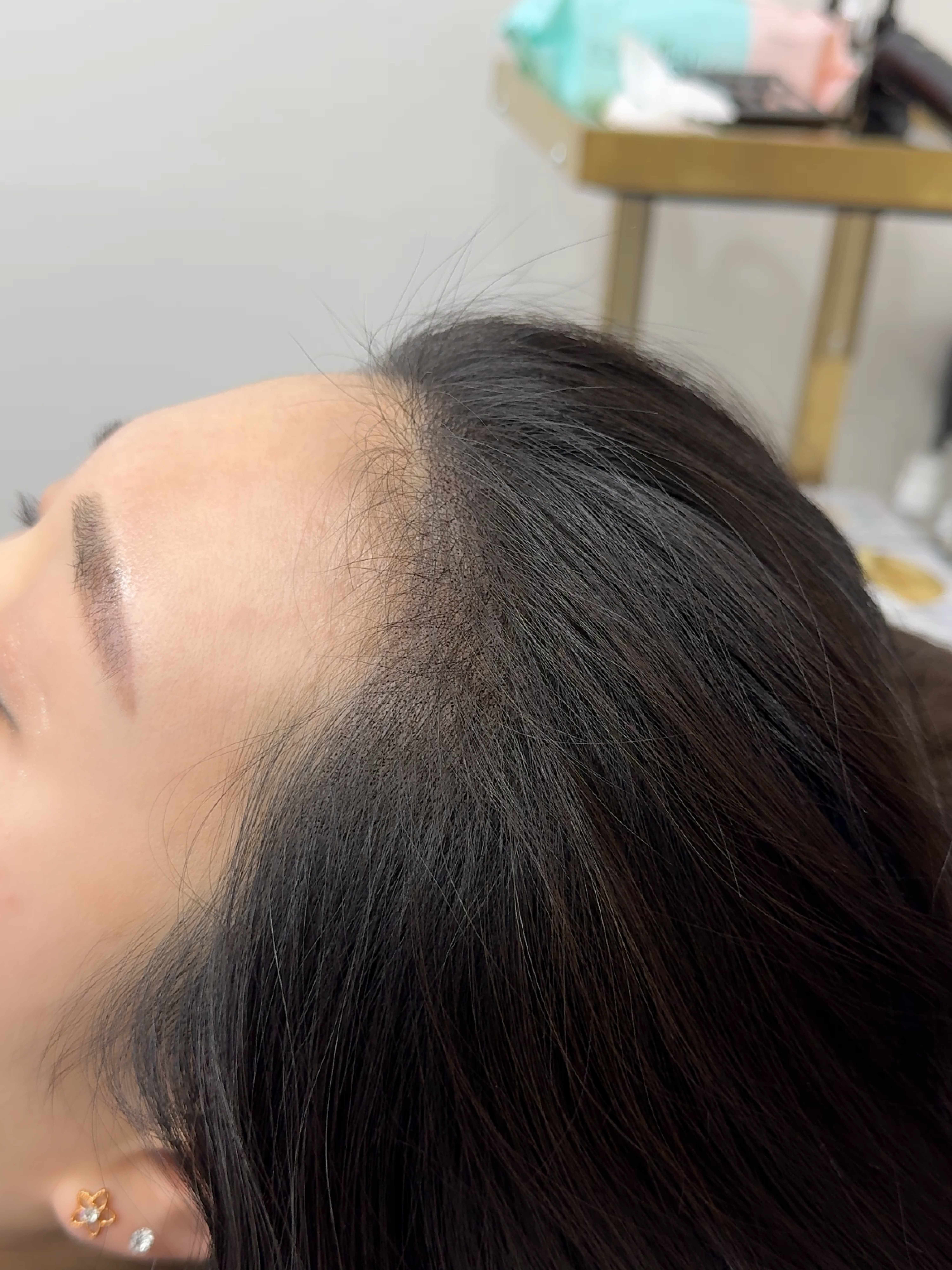 정수리 시술 후