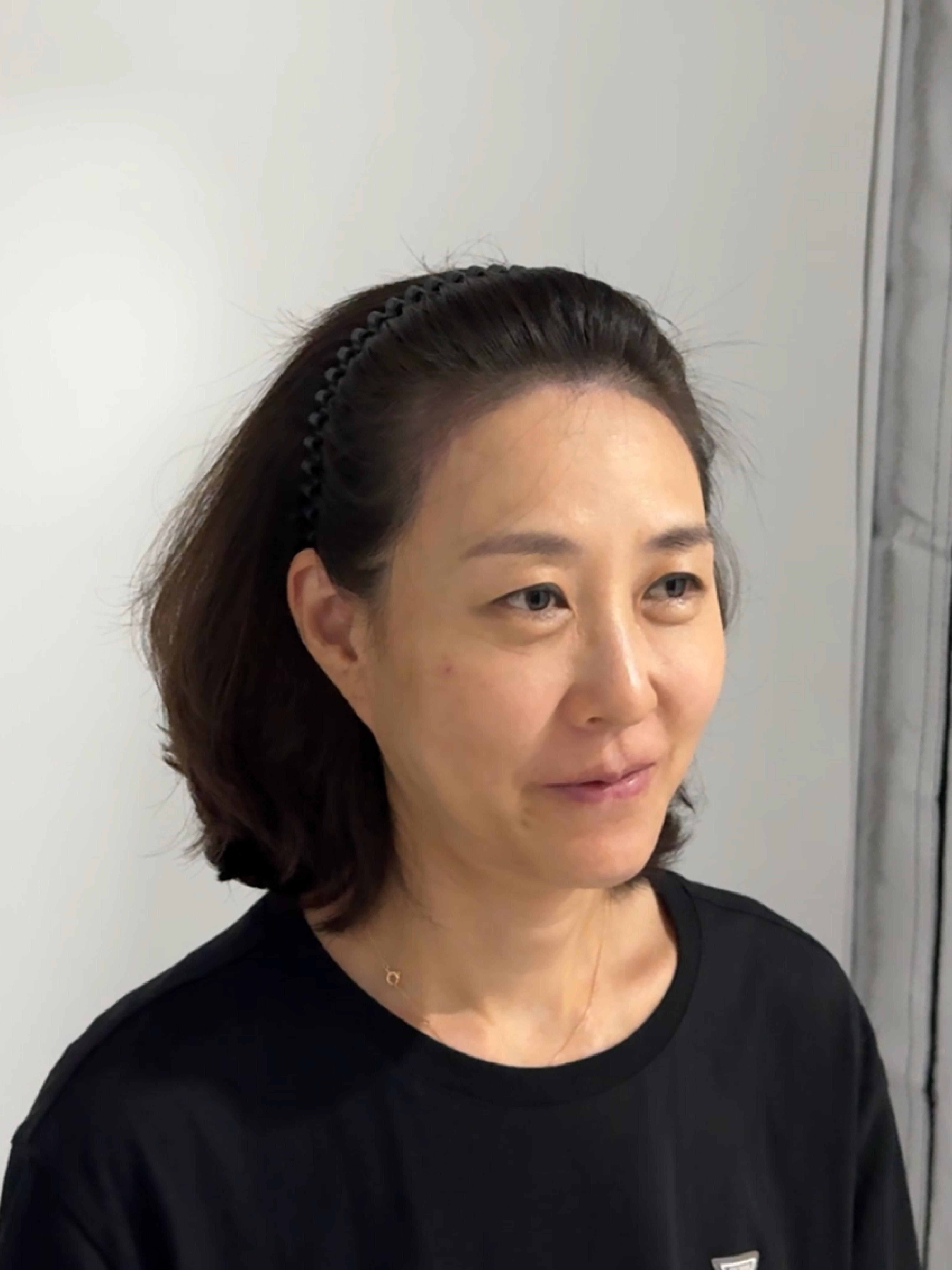 여성 헤어라인 시술 - 시술 후