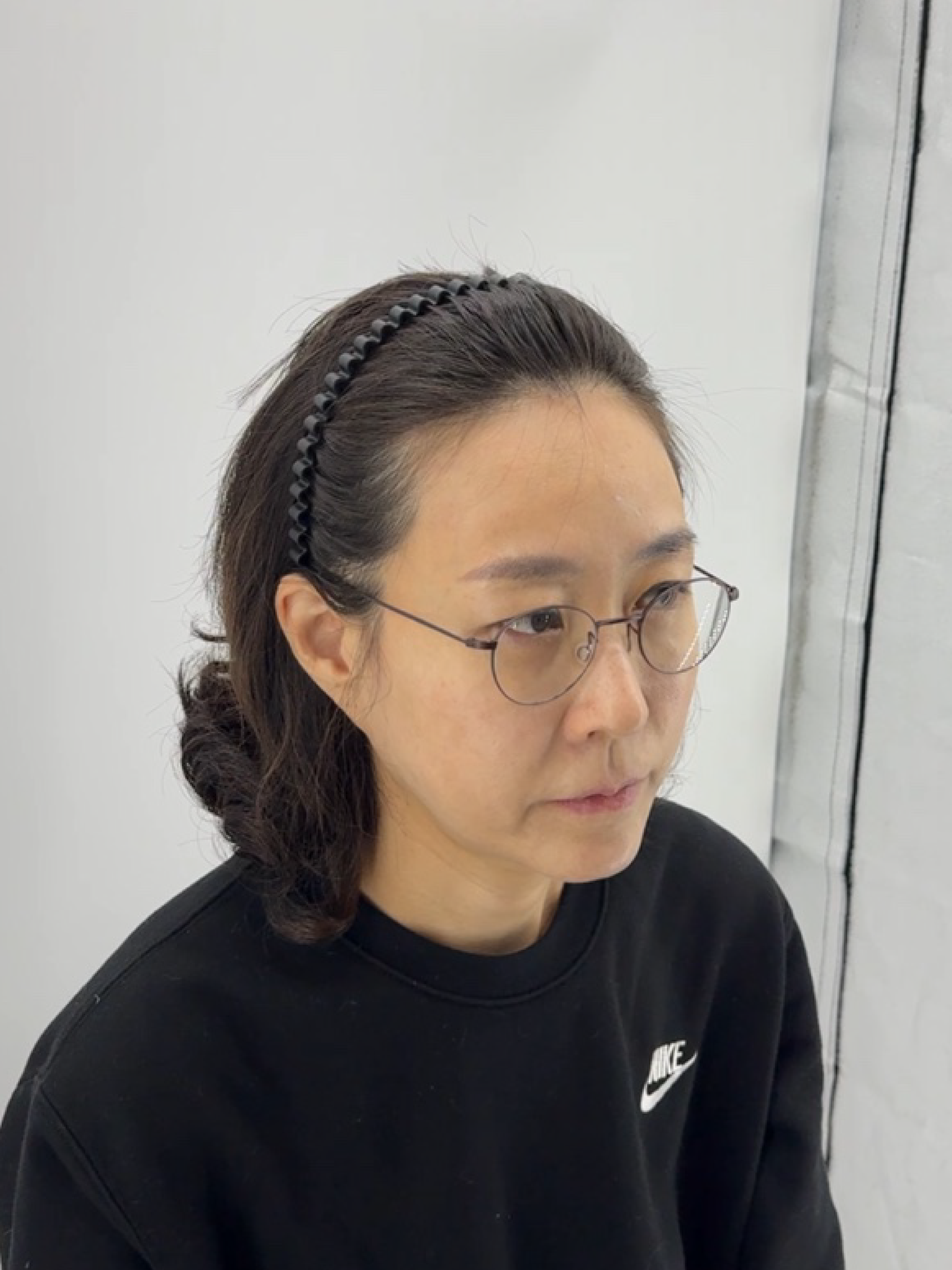 여성 헤어라인 시술 - 시술 전