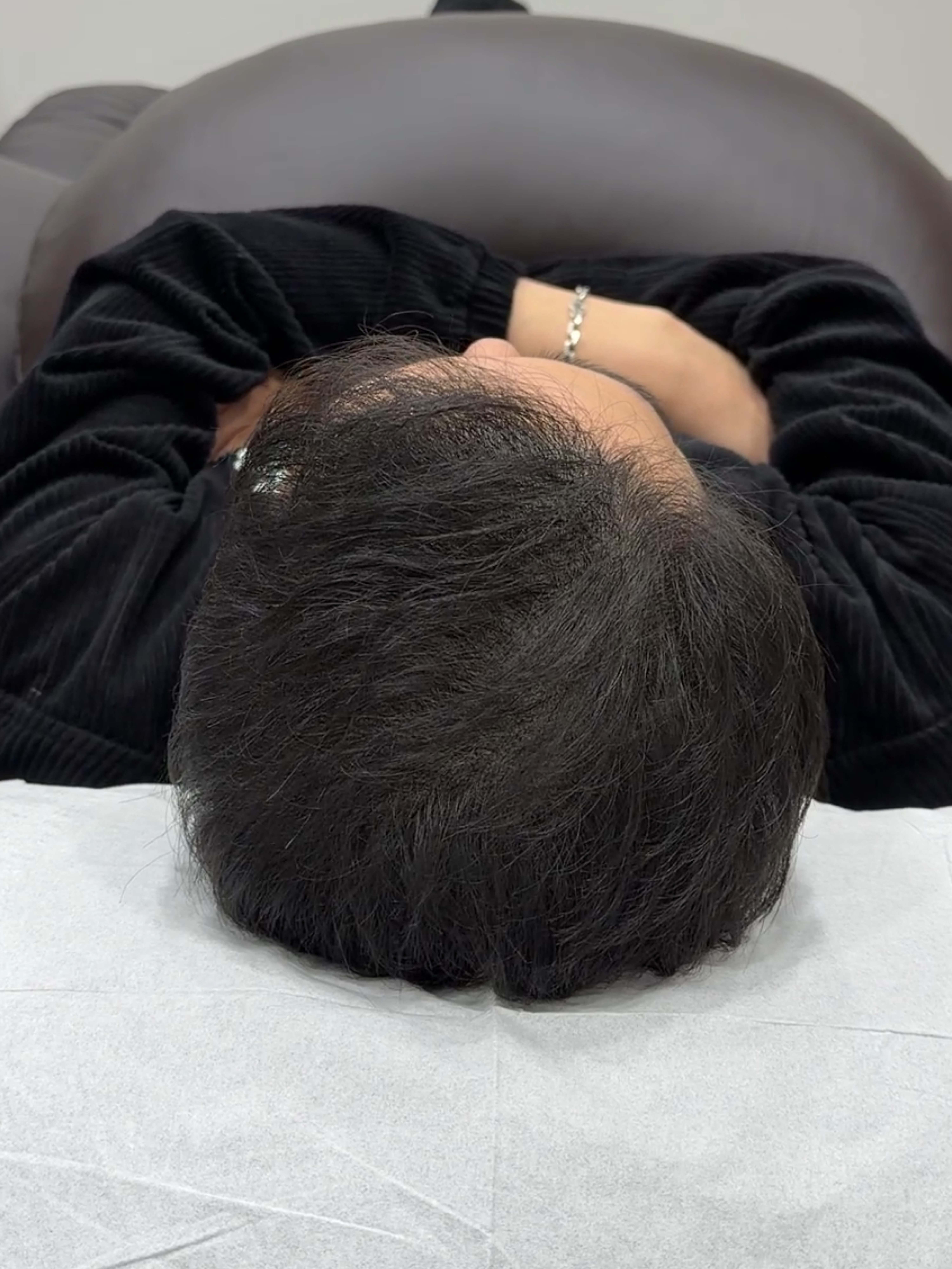 정수리 SMP 시술 - 시술 후