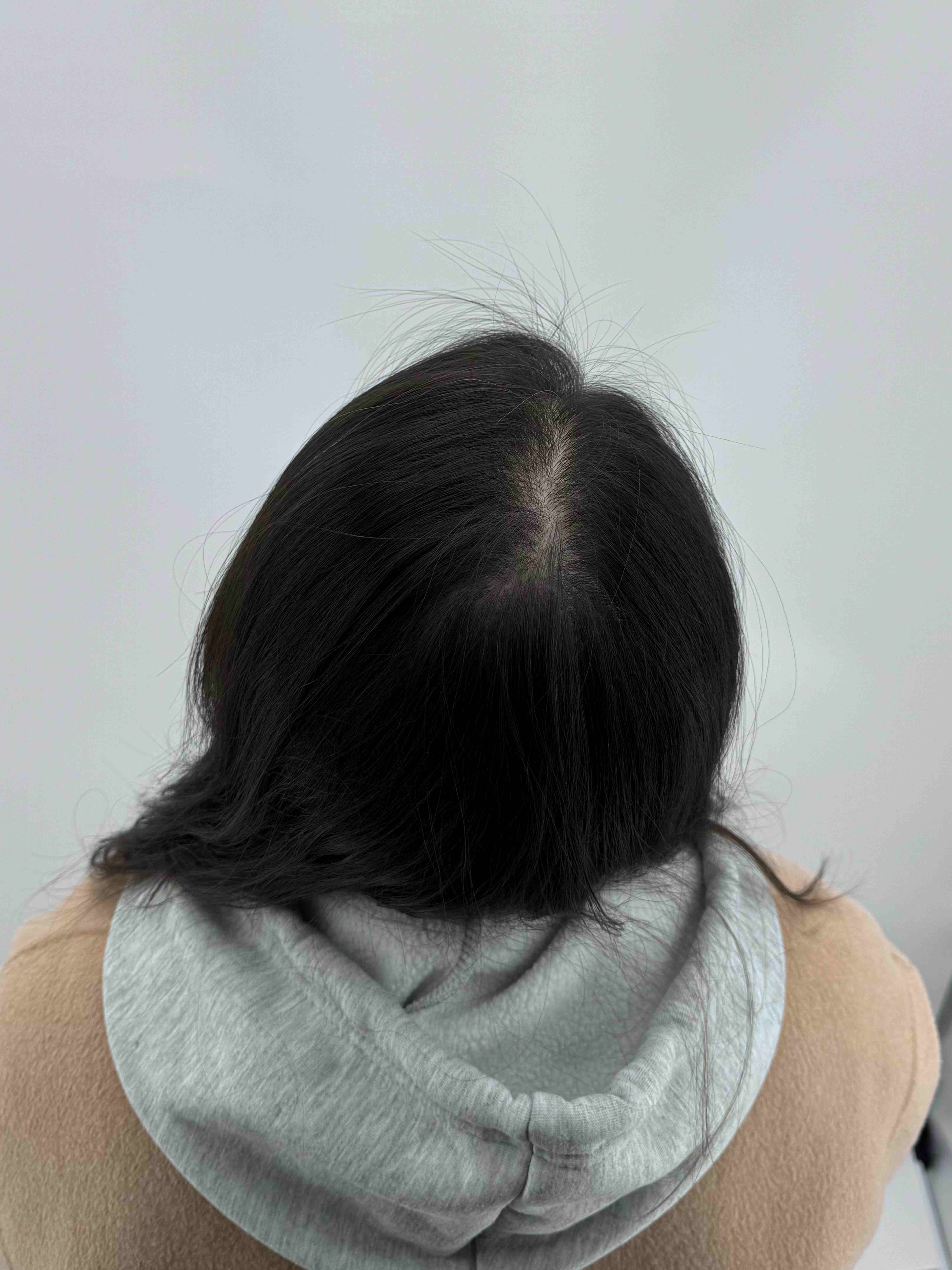 여성 정수리 시술 - 시술 전