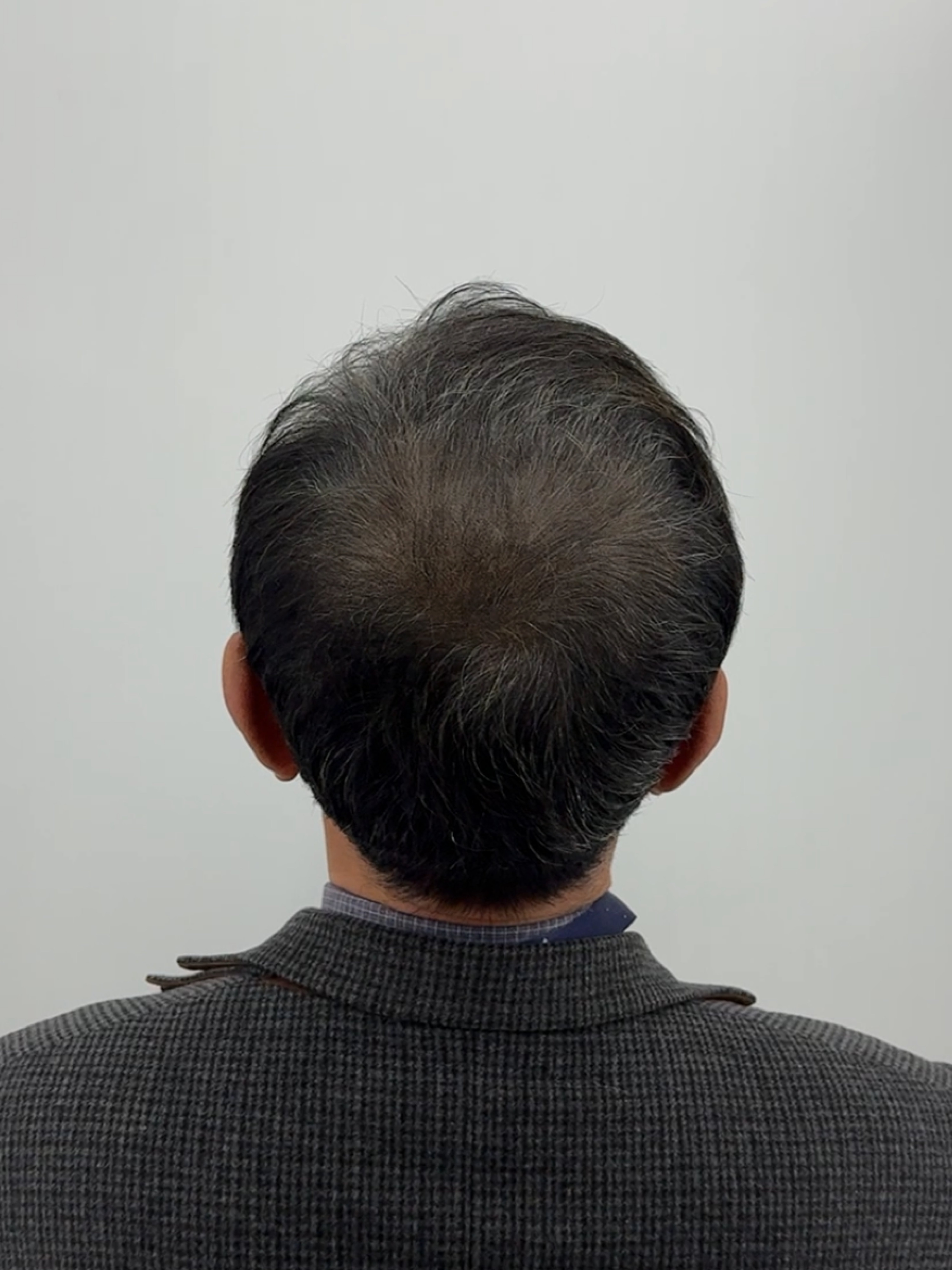 정수리 탈모 시술 - 시술 후