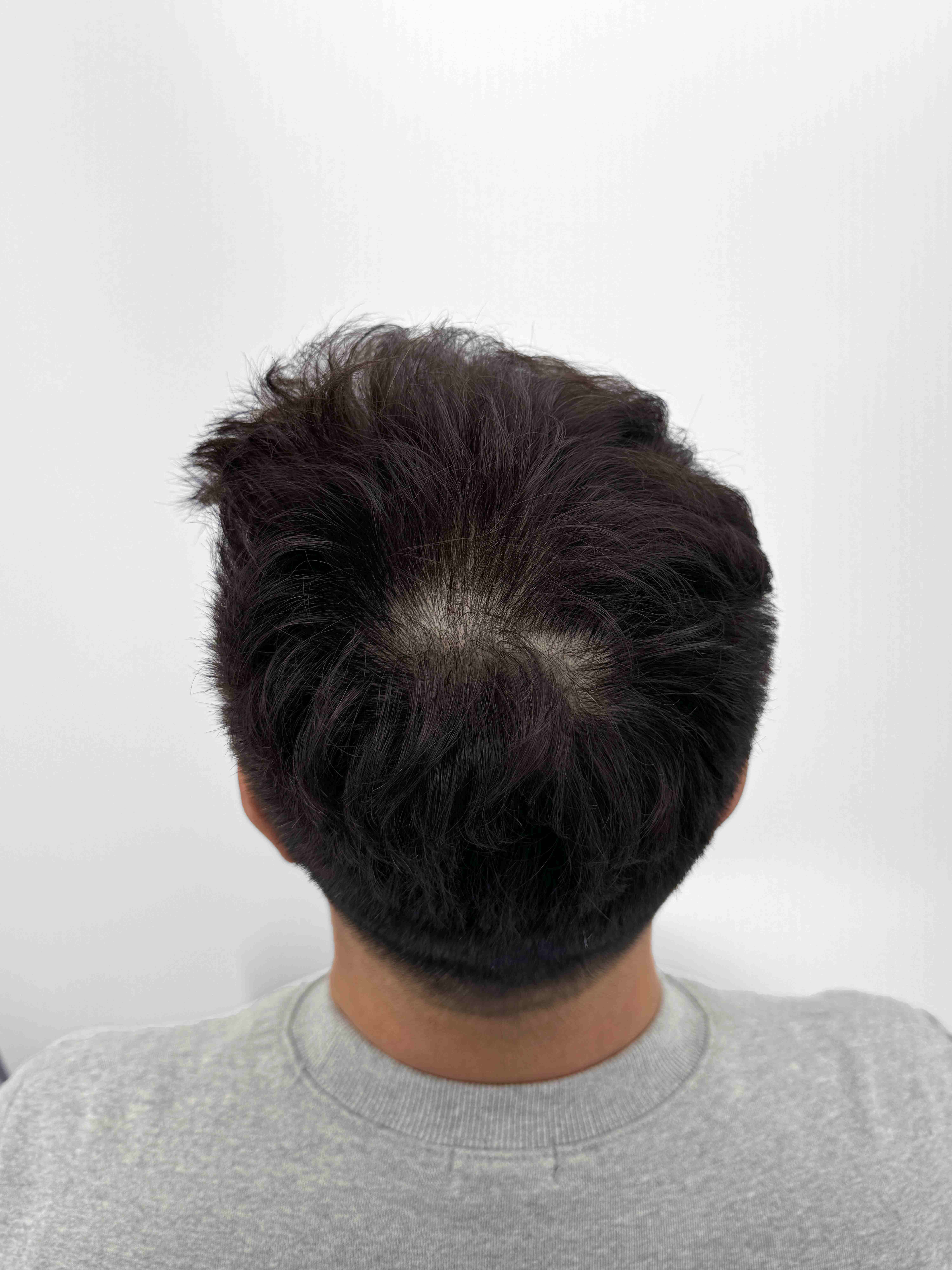 정수리 밀도 개선 - 시술 전