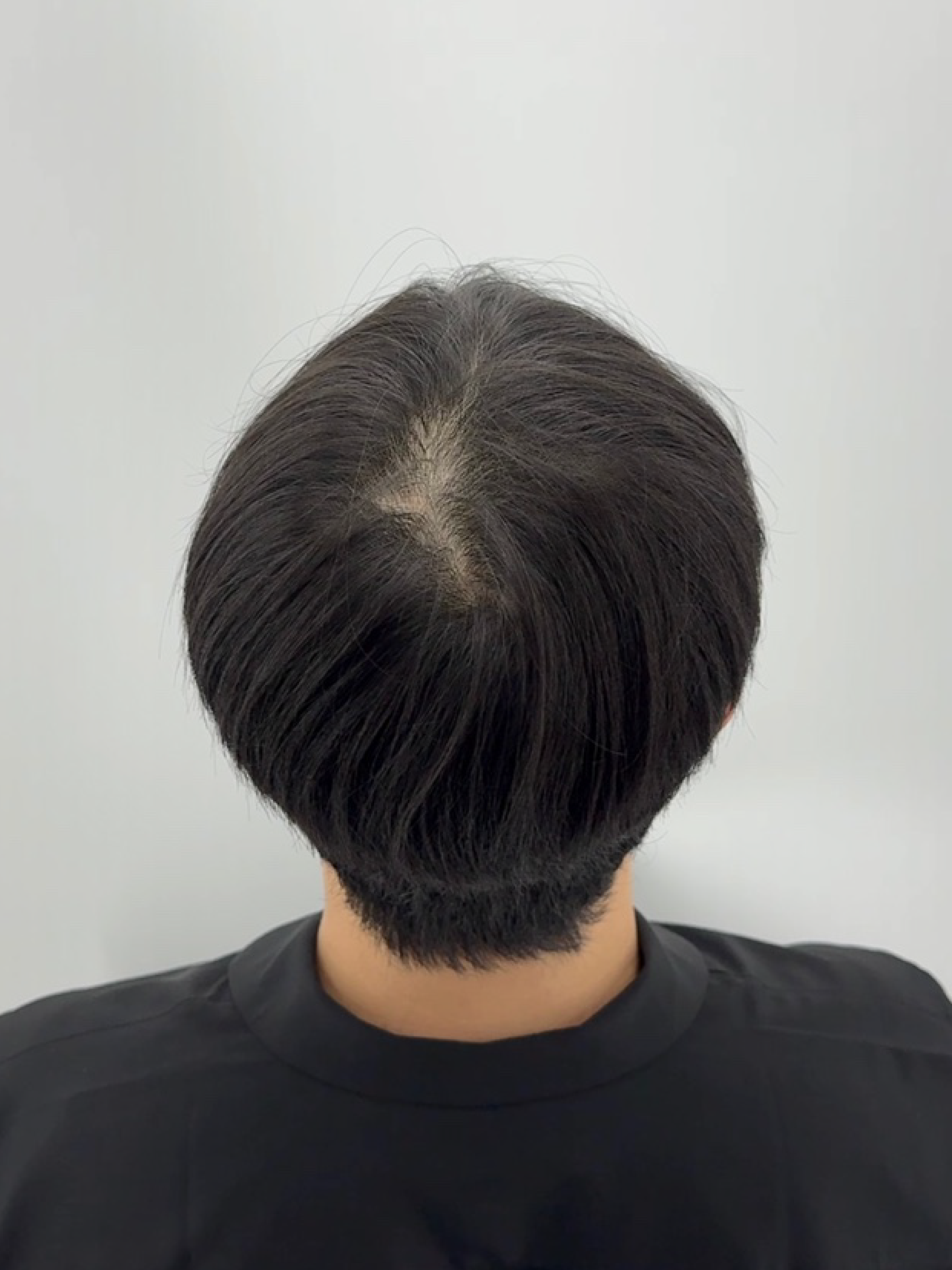 정수리 밀도 복원 - 시술 전