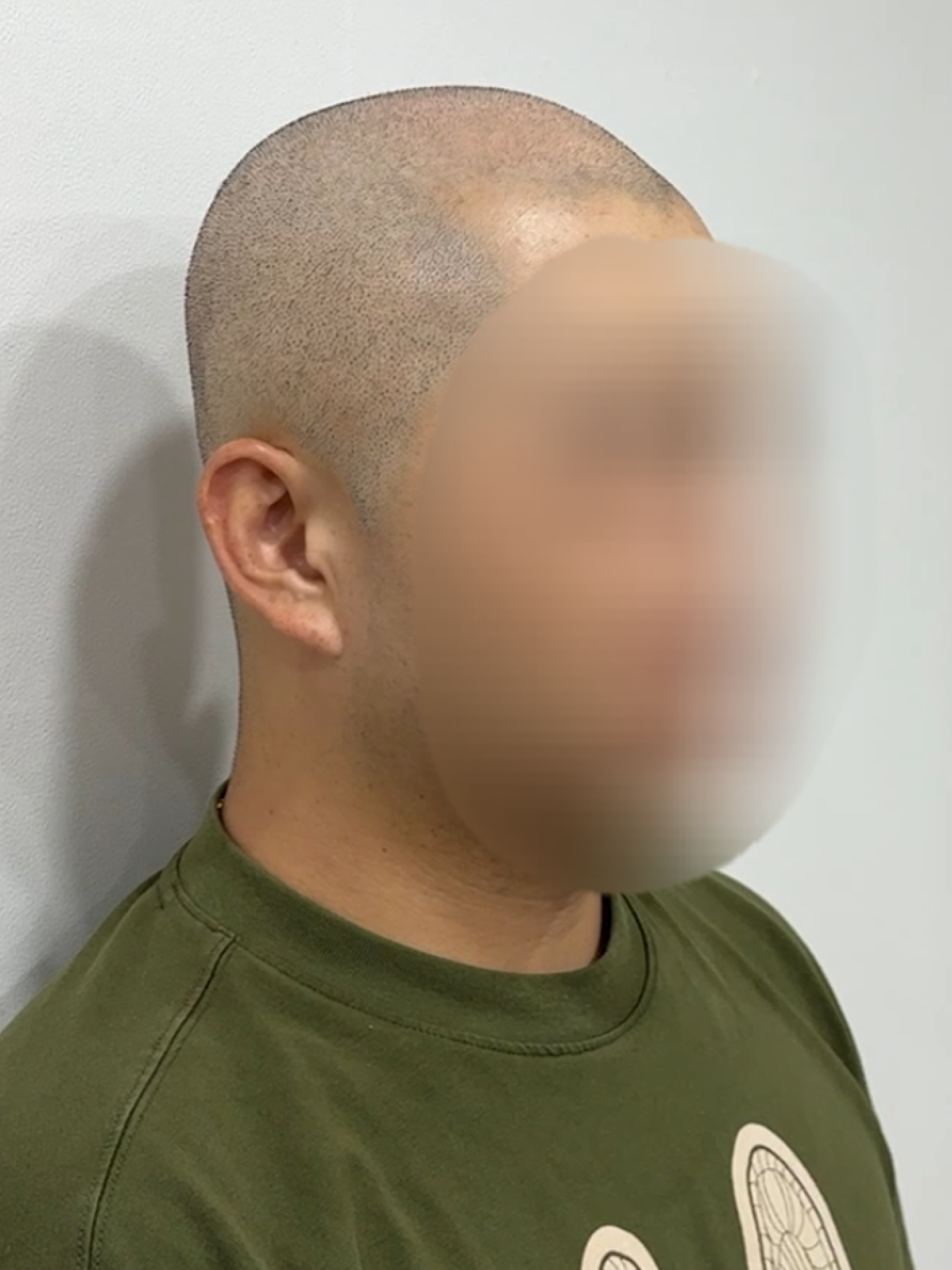 삭발 SMP 시술 - 시술 전