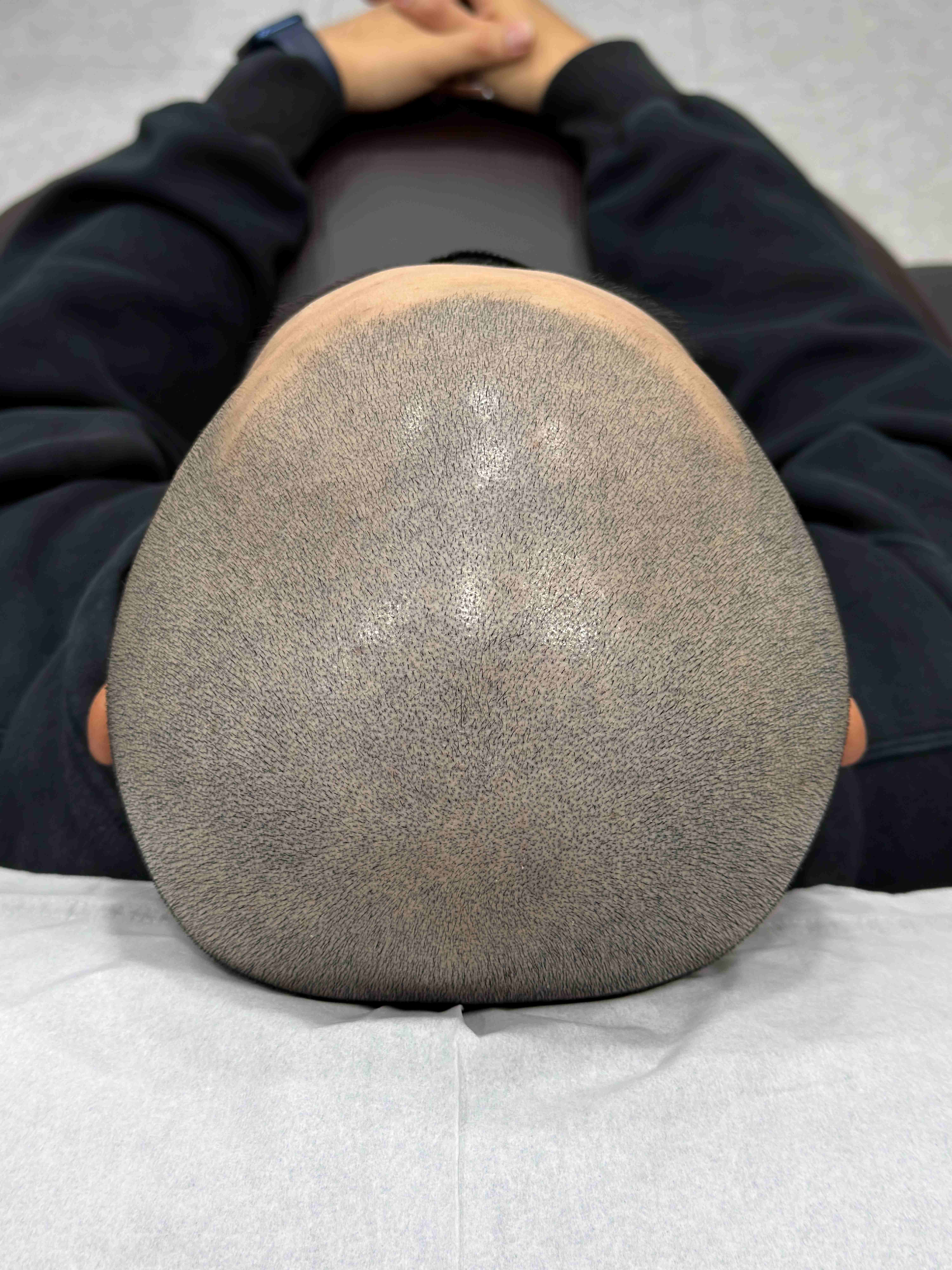 삭발 SMP 시술 - 시술 후