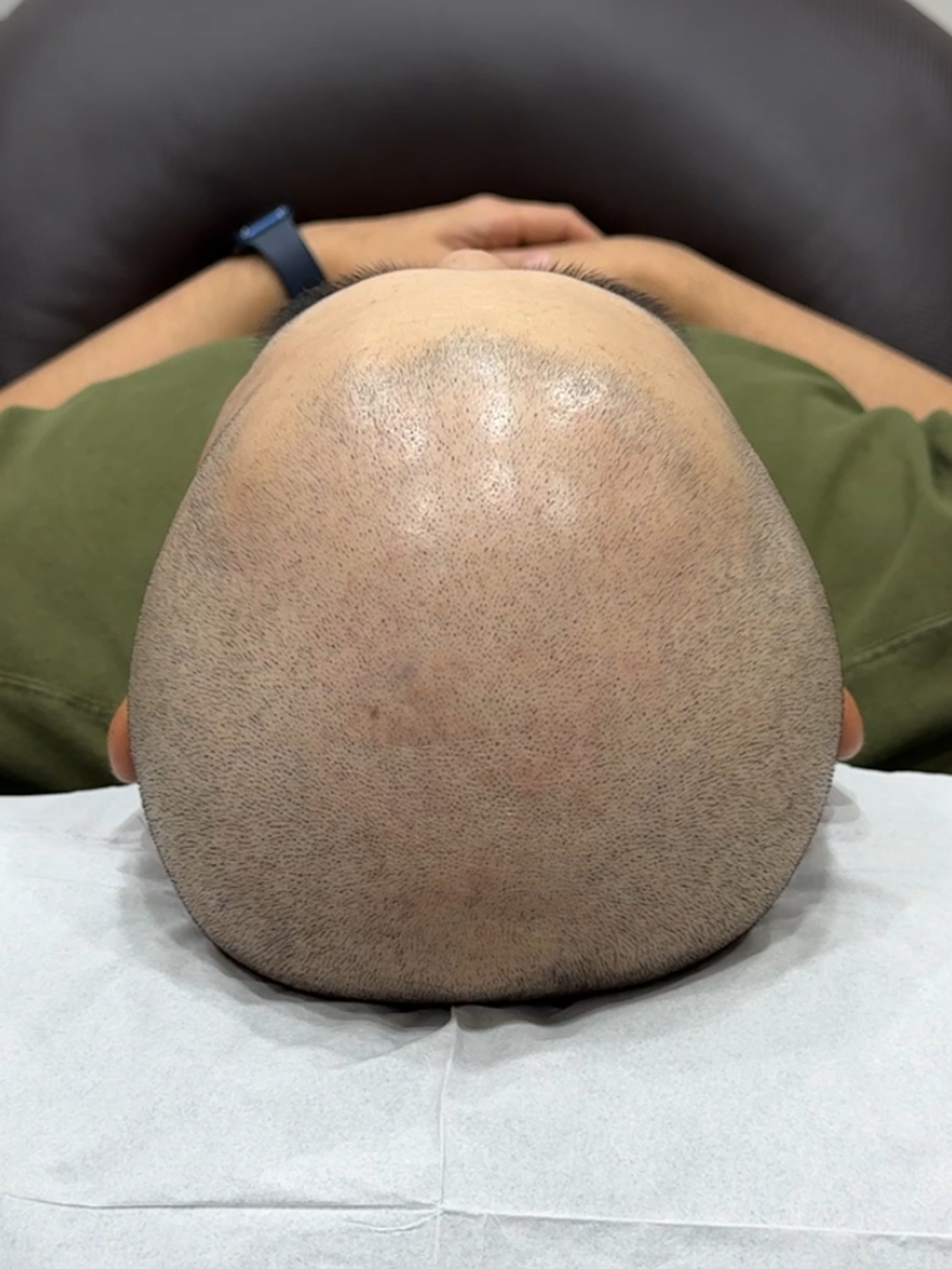 삭발 SMP 시술 - 시술 전