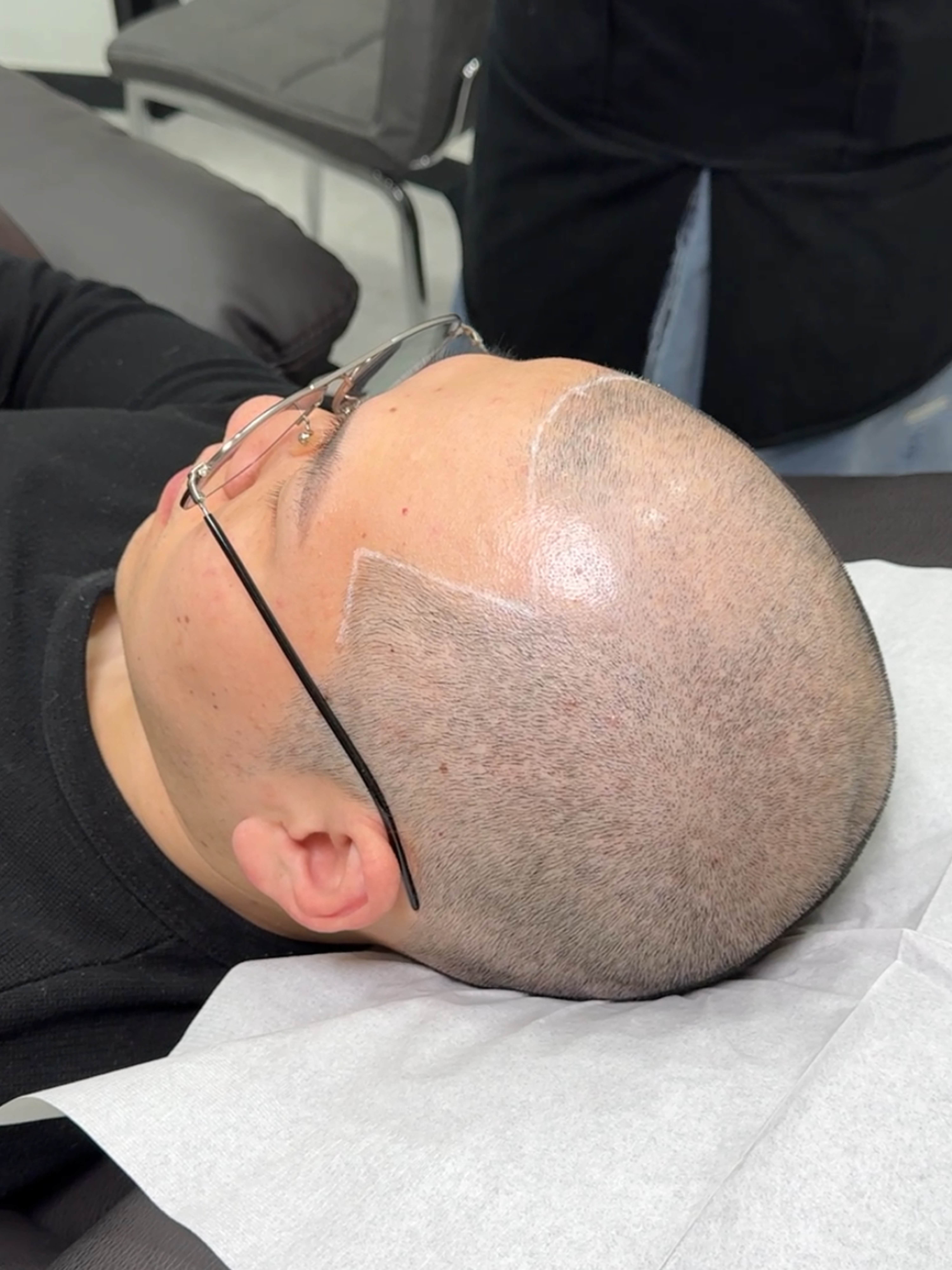 삭발 SMP 시술 - 시술 전