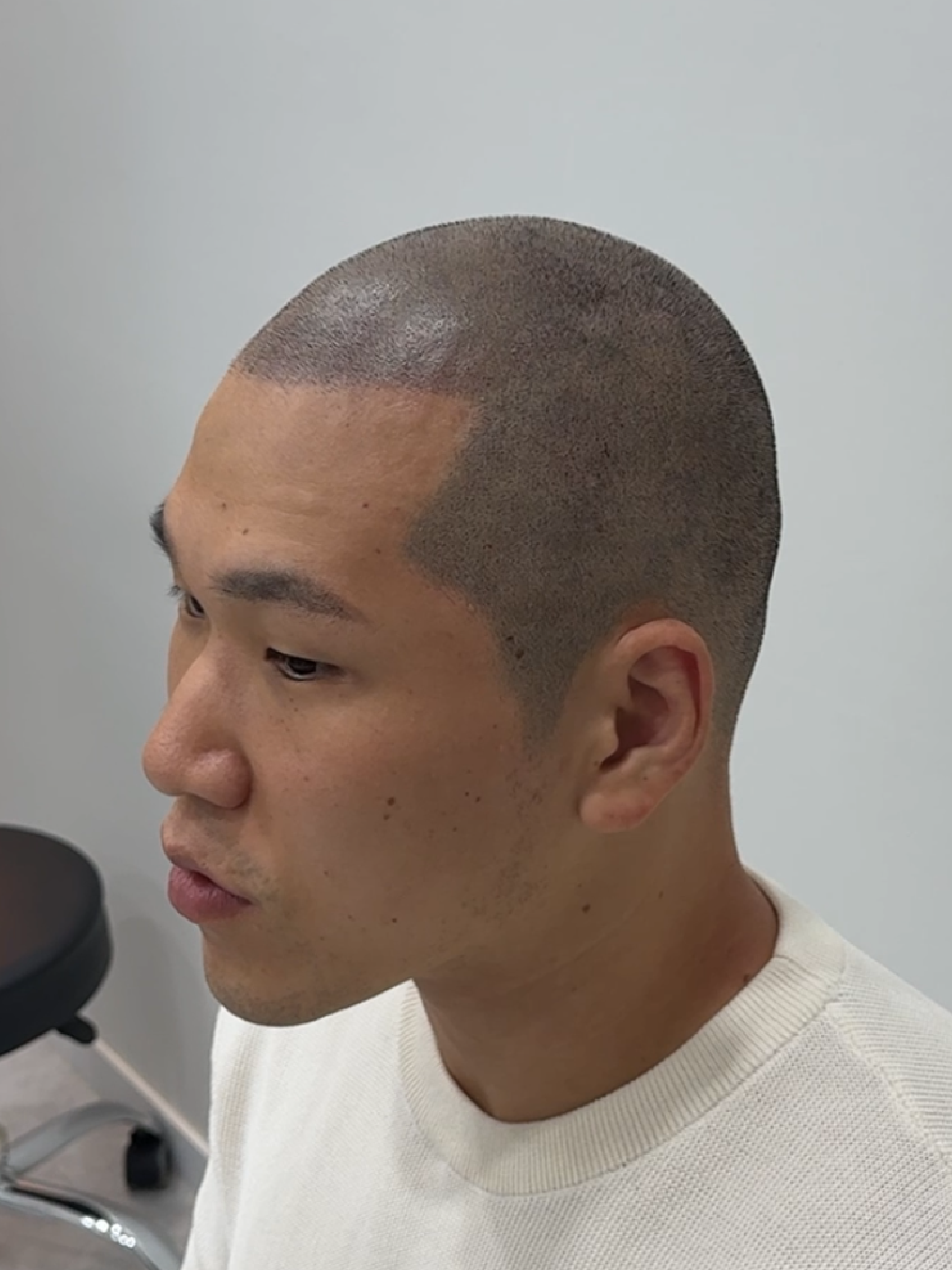 삭발 SMP 시술 후